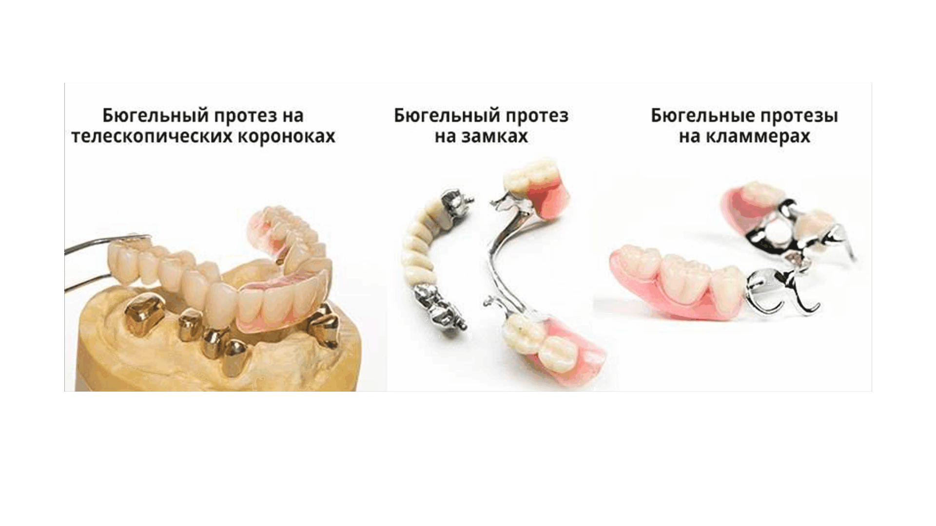 Плюсы бюгельных протезов. Бюгельный протез с аттачменами Bredent. Составные элементы бюгельных протезов. Составные элементы бюгельного протеза. Основные конструктивные элементы бюгельного протеза.